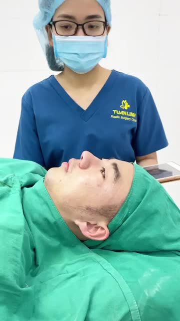 Case Nâng mũi siêu cấu trúc Có mài gồ Cho một khách hàng nam đến từ Nha Trang.