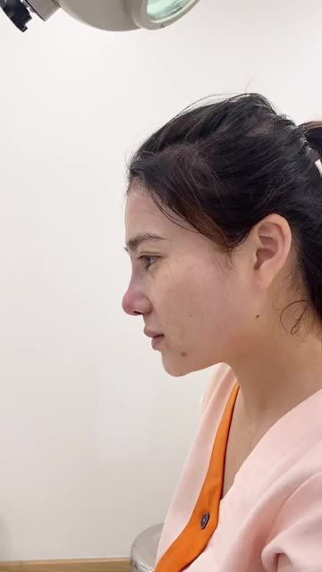 TÁI THẨM MỸ MŨI SAU TIÊM FILLER