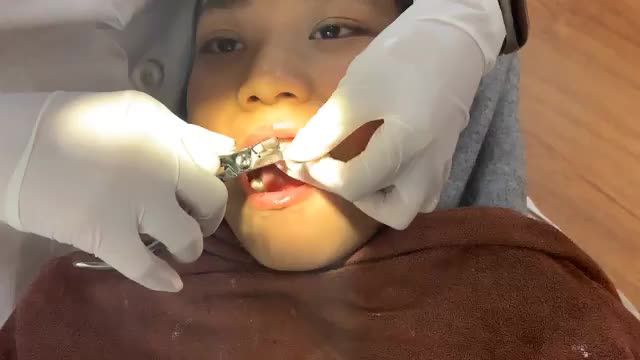 THÁO MẮC CÀI NIỀNG RĂNG CHO BỆNH NHÂN HÔ RĂNG, KHẤP KHỂNH
