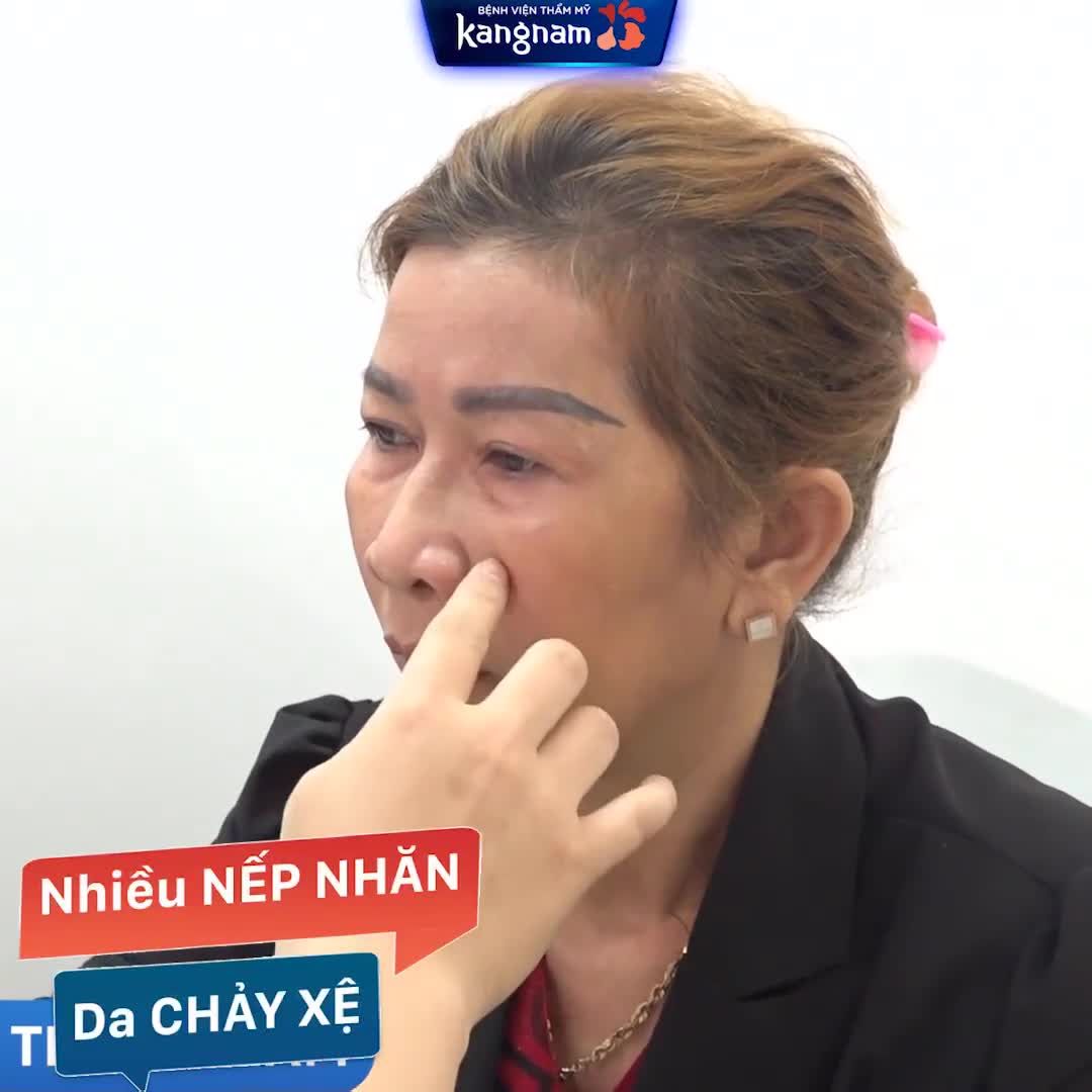 Kéo lại thanh xuân với combo CẤY MỠ MẶT CĂNG DA ️
