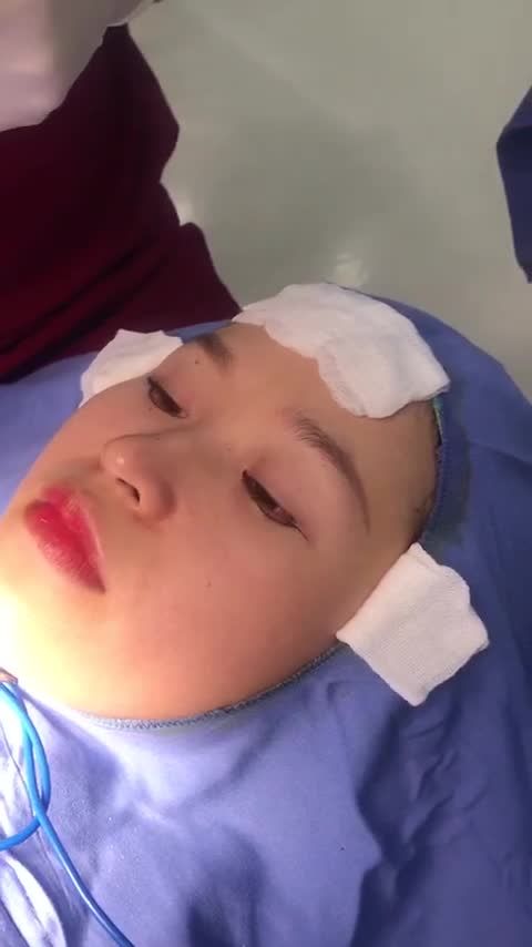 Thêm một ca "giải cứu" cắt mí hỏng do sai lầm cắt mí tại SPA