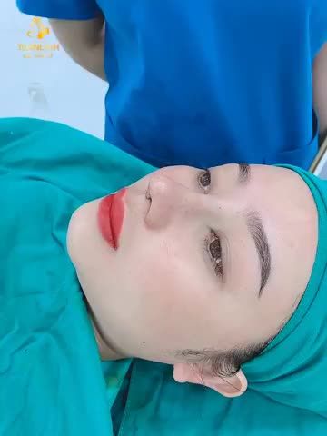 Case Nâng mũi siêu cấu trúc dáng mũi Angel Line