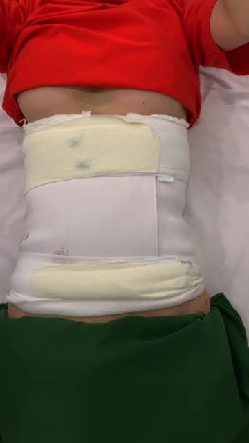 Hút mỡ bụng tái khám sau 5 ngày.