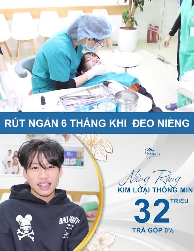NIỀNG RĂNG MẮC CÀI KIM LOẠI TỰ ĐỘNG