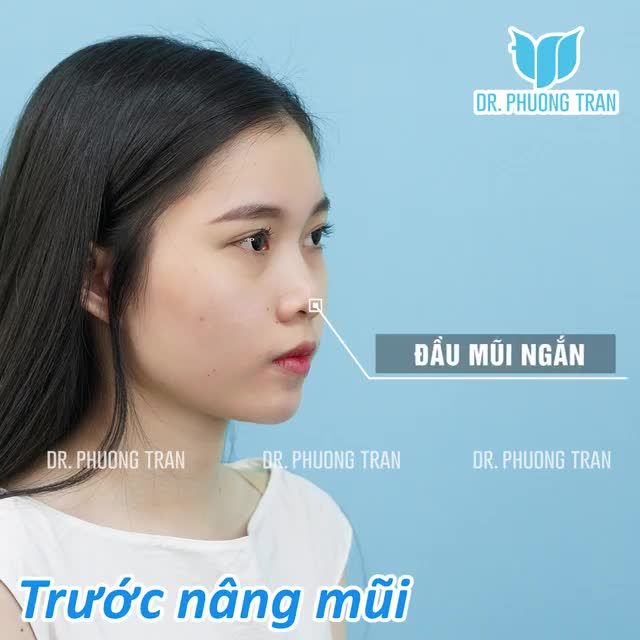 Xinh lại càng xinh sau 14 ngày nâng mũi bọc sụn