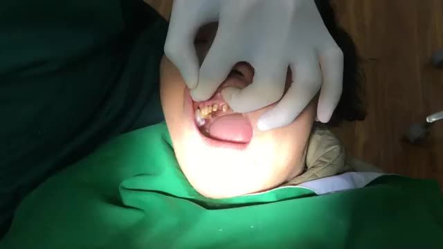 Lắp răng sứ mới thay thế răng sứ cũ cho cô khách hàng.