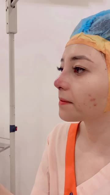 Mũi to bè hóa thon gọn, tự nhiên chỉ sau 90 phút