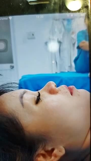 Nâng mũi bán cấu trúc 2 lớp Kết hợp cuộn cánh mũi plasma