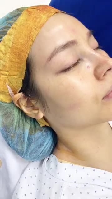 Sự cải thiện bất ngờ sau khi thực hiện nâng mũi cấu trúc do BS Khải thực hiện.
