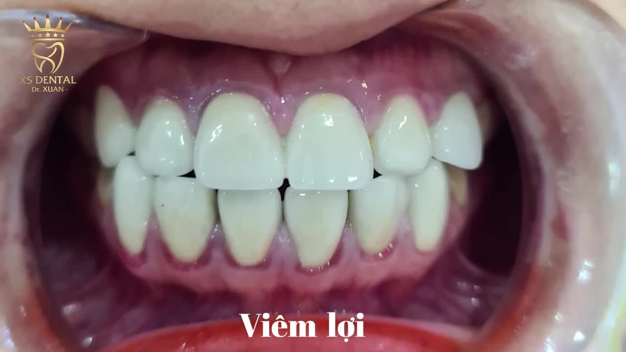 Cảm nhận thực tế kh Hoàn thành xong ca thẩm mỹ 12 răng sứ tại nha khoa XS .