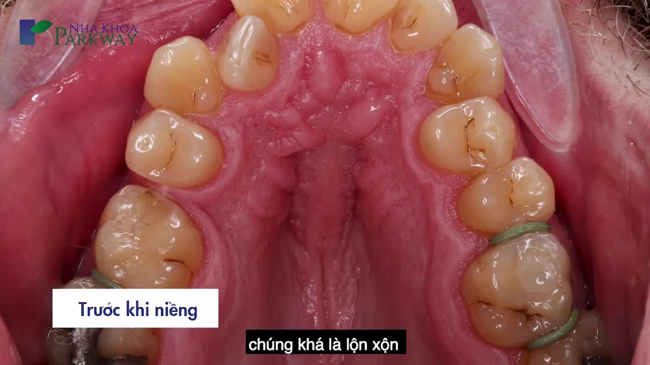 HÀNH TRÌNH 17 THÁNG NIỀNG RĂNG TẠI PARKWAY CỦA CHÀNG TRAI NGOẠI QUỐC