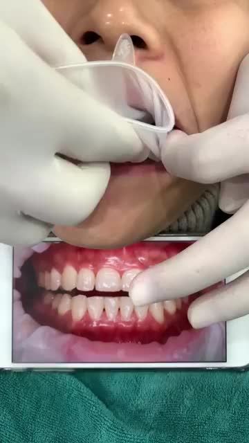 Khách hàng thử răng veneer case mài siêu ít tại VIET SMILE