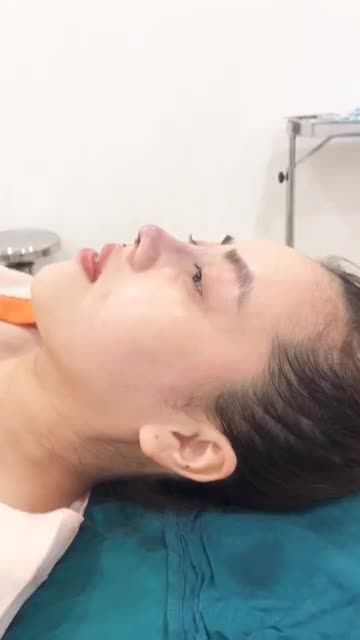Khi nào nên bọc cân cơ thái dương (fascia) trong nâng mũi?