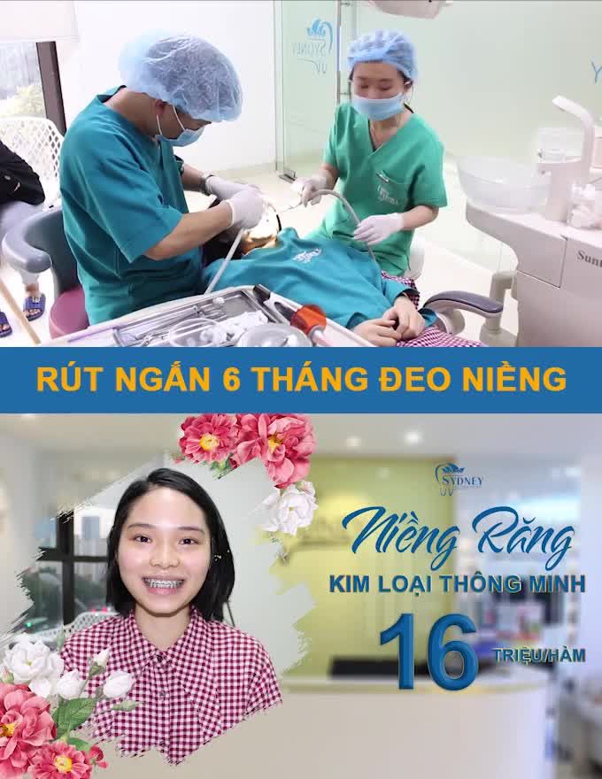 MẮC CÀI KIM LOẠI THÔNG MINH GIÚP KHẮC PHỤC RĂNG HÔ, KHẤP KHỂNH, MÓM... NHANH HƠN MẮC CÀI THÔNG THƯỜNG.