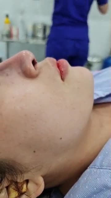 MŨI BÁN CẤU TRÚC VỪA THỰC HIỆN ĐẸP NGAY SAU LÀM KHÔNG SƯNG BẦM!!!