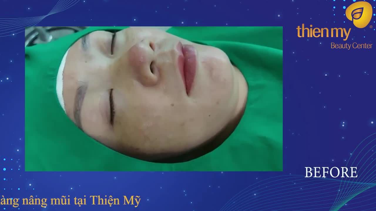 Nâng mũi Nano Silk một thay đổi nhỏ một khác biệt lớn