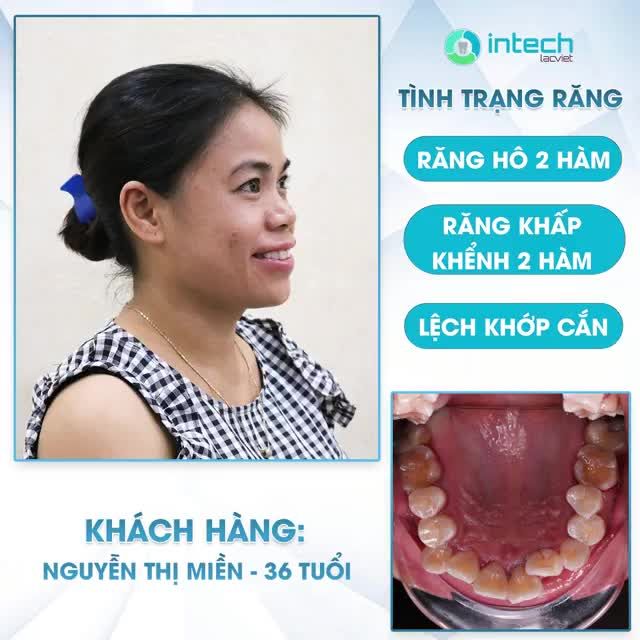 NIỀNG RĂNG HÔ HIỆU QUẢ CHỈNH NHA RÕ RỆT