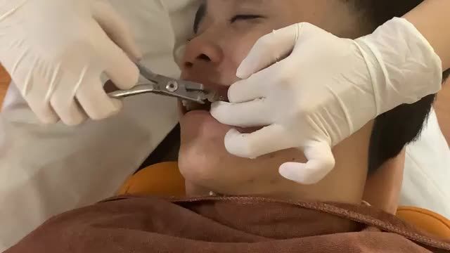 THÁO MẮC CÀI cho bệnh nhân răng KHẤP KHỂNH