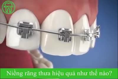 Thưa răng tuy không gây hại đến sức khỏe răng miệng nhưng lại tạo nên một vài ảnh hưởng về chức năng ăn nhai thẩm mỹ.