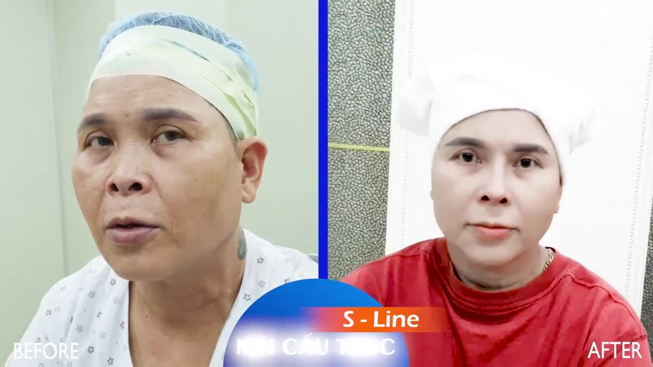 TUỔI TRUNG NIÊN CÓ NÊN NÂNG MŨI?