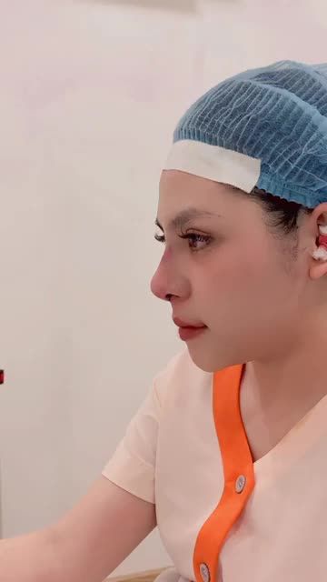 Tái cấu trúc cho khách hàng từng nâng mũi bọc sụn