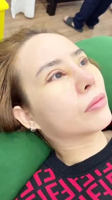 Tái khám sau 10 ngày COMBO mũi cấu trúc, mở góc mắt trong/ngoài và cắt mí.