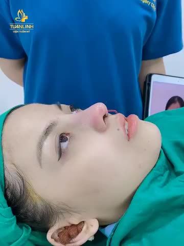 Case nâng mũi siêu cấu trúc Surgiform sửa lại sau 90 phút