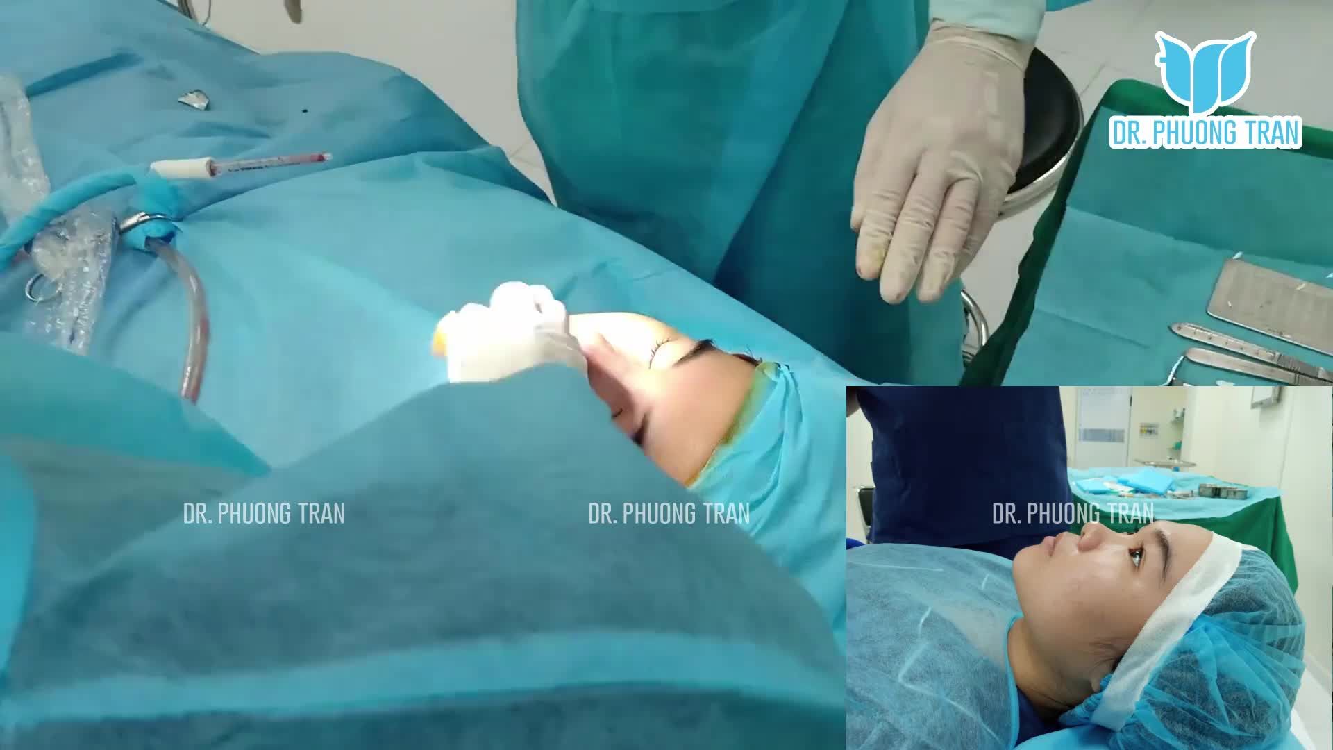 Kết thúc ngày với ca mũi cấu trúc ưng ý