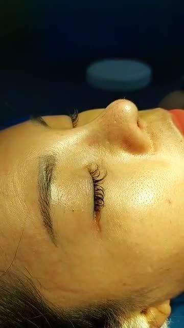 Nâng mũi bán cấu trúc đa lớp Khắc phục mũi lộ sống, mũi lệch , mũi ngắn hếch sau 2 lần pt ở cơ sở khác