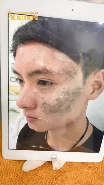 CHÀM BỚT DI TRUYỀN 3 ĐỜI, ĐẾN ĐỜI TÔI HẾT CHÀM BỚT NHỜ XUÂN HƯƠNG