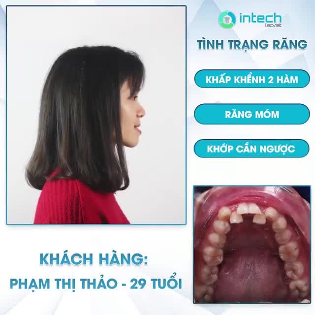 TẠM BIỆT RĂNG MÓM  BẮT ĐẦU HÀNH TRÌNH THAY ĐỔI VỚI NIỀNG MẮC CÀI SỨ