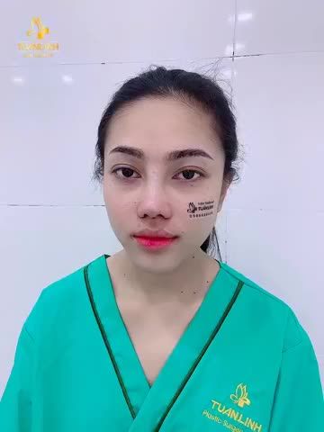 DÁNG MŨI ANGEL LINE ĐỘC QUYỀN NHÀ TUẤN LINH