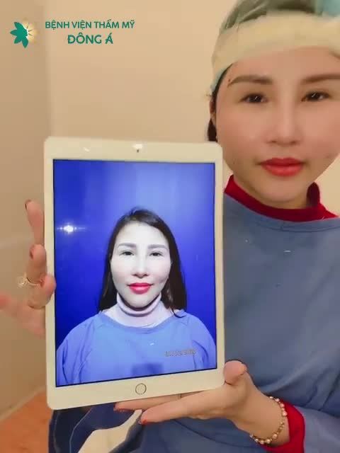 Sau 45p CẤY MỠ MẶT Biogen, cả nhà có ai đoán được tuổi thật của chị KH này không ạ?