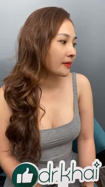 Dáng mũi cấu trúc surgiform tái khám sau 3 tháng.