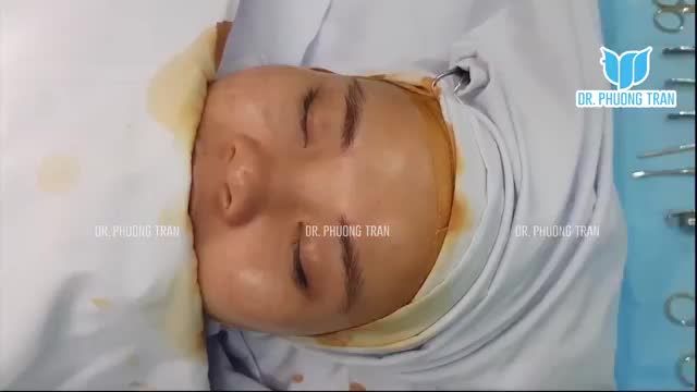 BÁC SĨ PHÂN TÍCH TRỰC TIẾP CÁC TIÊU CHUẨN CẦN CÓ CỦA MỘT CA MŨI CẤU TRÚC SỤN SƯỜN TOÀN PHẦN