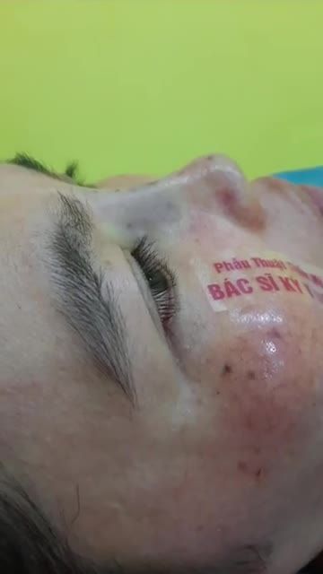 Khách Hàng Nâng mũi Bs Kỳ Y Dược Nâng mũi bán cấu trúc 2 lớp Kết quả sau 45 phút thực hiện