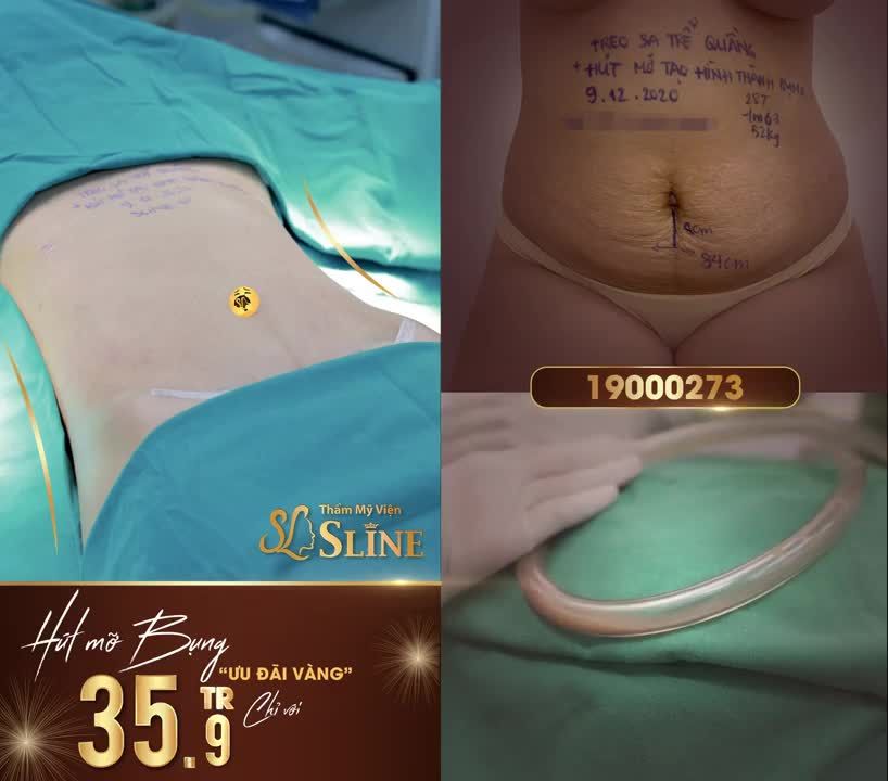 HÚT MỠ BỤNG TRỌN GÓI