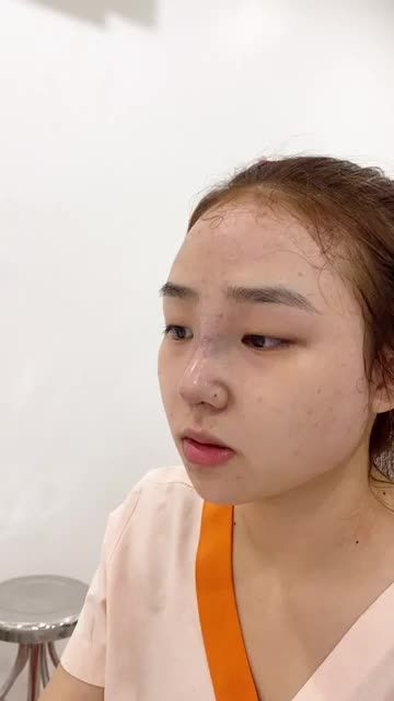 Lợi ích việc xem lại dáng mũi trước khi đóng vết khâu