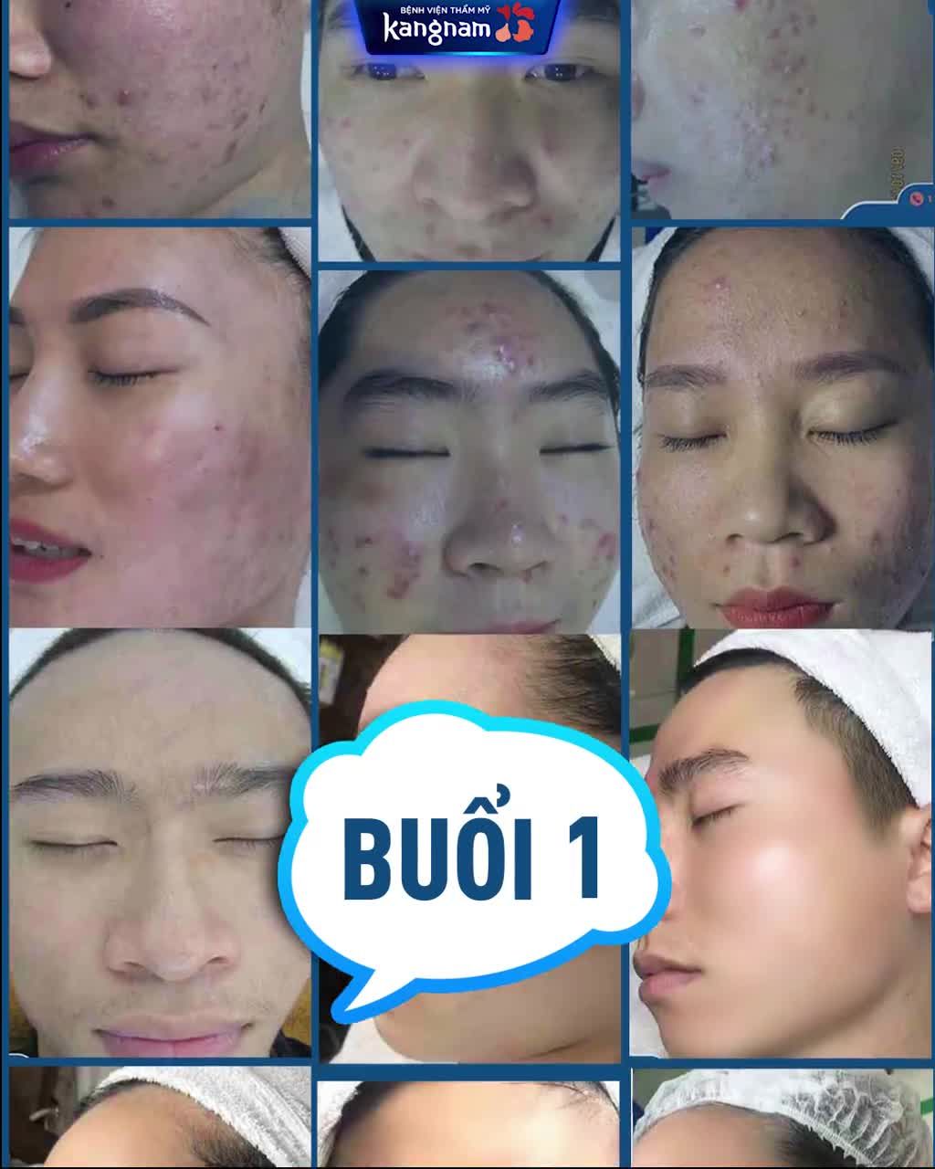 Công nghệ Trị mụn tận gốc De-acne OFF tới 50%  Da sạch mụn, trắng mịn Nhắn nhận ưu đãi ngay!