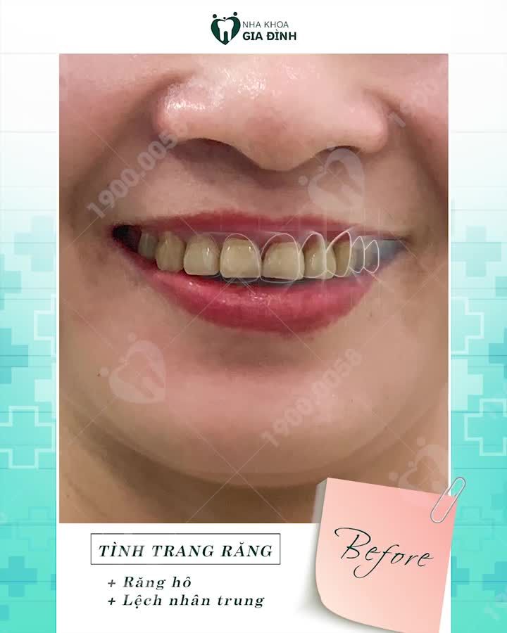 RĂNG TRẮNG SÁNG RẠNG RỠ ĐÓN XUÂN SANG