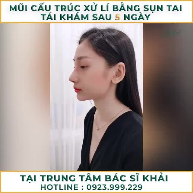 Tiếp tục series phản hồi dáng mũi đẹp của Khách hàng đã chọn phương pháp nâng mũi cấu trúc tại trung tâm BS Đỗ Quang Khải