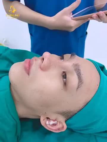 NÂNG MŨI CẤU TRÚC CHO NAM
