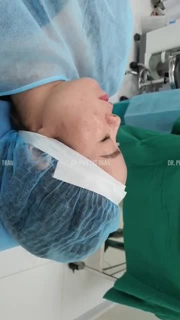Chuẩn bị cho một ca nâng mũi cấu trúc sụn tai Surgiform.mời các bạn theo dõi hình ảnh trước phẫu thuật cũng như kế hoạch phẫu thuật của bác sĩ