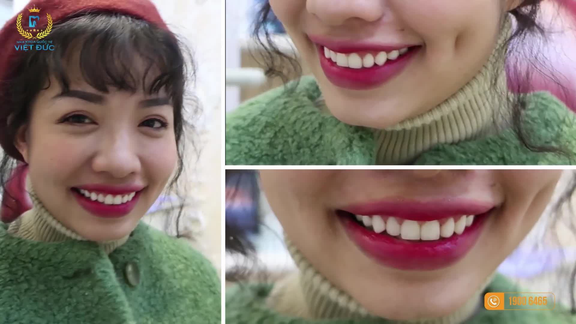 “BỌC RĂNG SỨ TẠI NHA KHOA QUỐC TẾ VIỆT ĐỨC RẤT ĐẸP VÀ NHẸ NHÀNG”