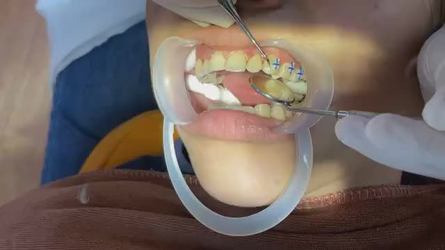Gắn mắc cài cho bệnh nhân răng KHẤP KHỂNH HÔ