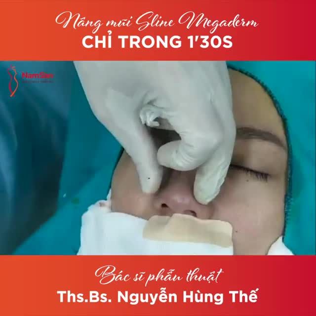 Hoàn thành một ca NÂNG MŨI Sline Megaderm CHỈ TRONG 1’30s