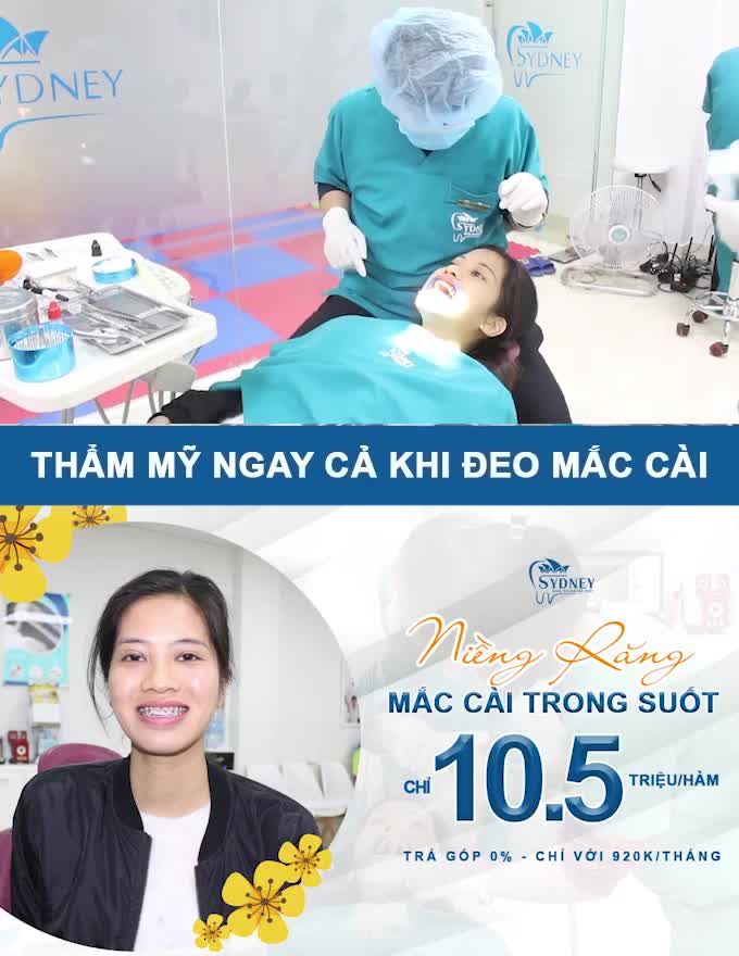 CHỈNH NHA RĂNG HÔ VỚI MẮC CÀI PHA LÊ