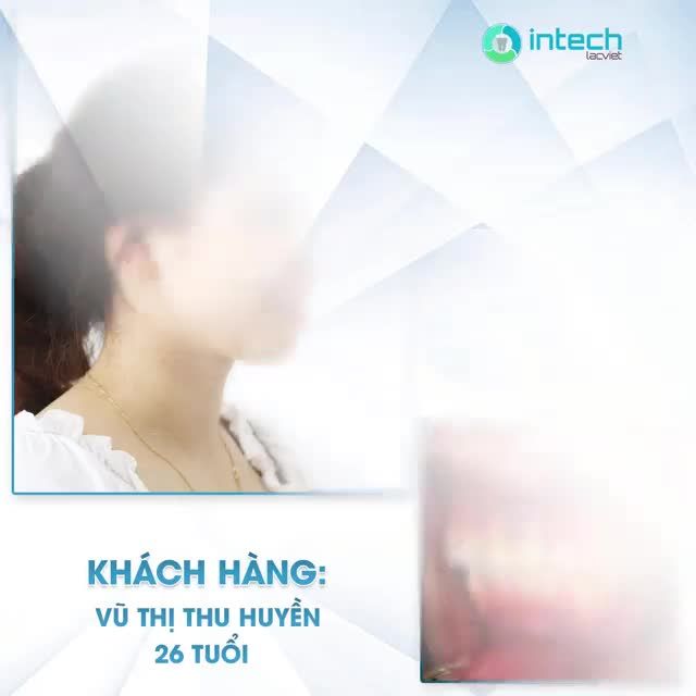 THAY ĐỔI THẨM MỸ KHUÔN MẶT CHỈ SAU 5-6 THÁNG NIỀNG RĂNG