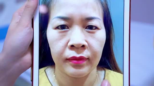 Cận cảnh ca Combo Cắt mí kết hợp nâng cung mày, khắc phục tình trạng sụp mí; da phủ mí dày, bọng mỡ thừa nhiều.....Kết quả đẹp hơn mong đợi là có thật