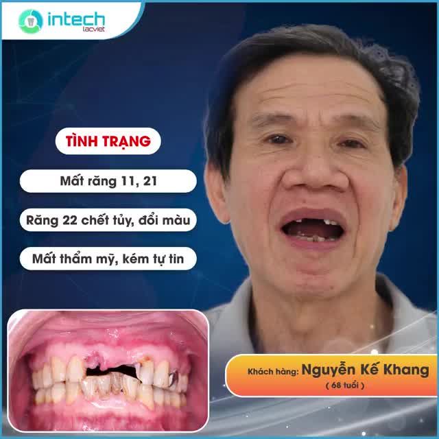 TRỒNG RĂNG IMPLANT KHÔI PHỤC NỤ CƯỜI HOÀN MỸ